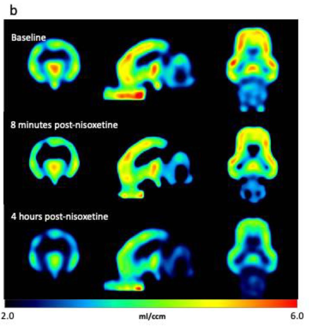 [11C]yohimbine PET parametric maps of a minipig brain in three views, at baseline, 8 minutes and 4 hours after nisoxetine; colour scale 2.0 to 6.0 mL/ccm.