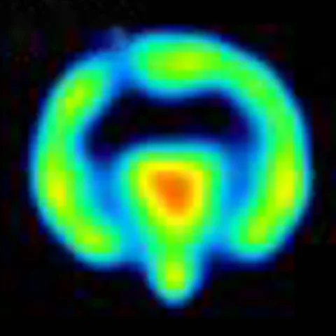 Coronal PET map at baseline.